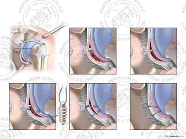 Left Arthroscopic Repair of Bankart Lesion with Two Suture Anchors