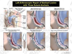 Left Arthroscopic Repair of Bankart Lesion with Three Suture Anchors