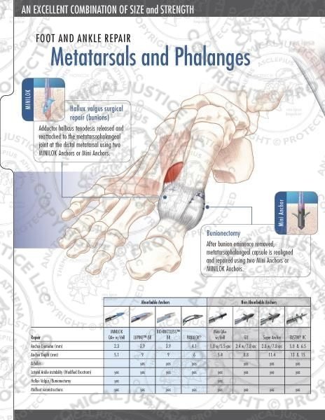 Small Joint Anchors with Orthocord Brochure