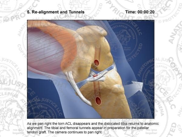 ACL Reconstruction Surgical Storyboards
