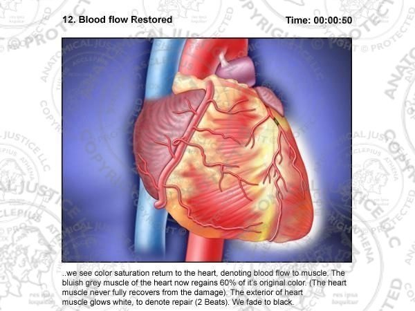 Coronary Artery Stent Storyboards