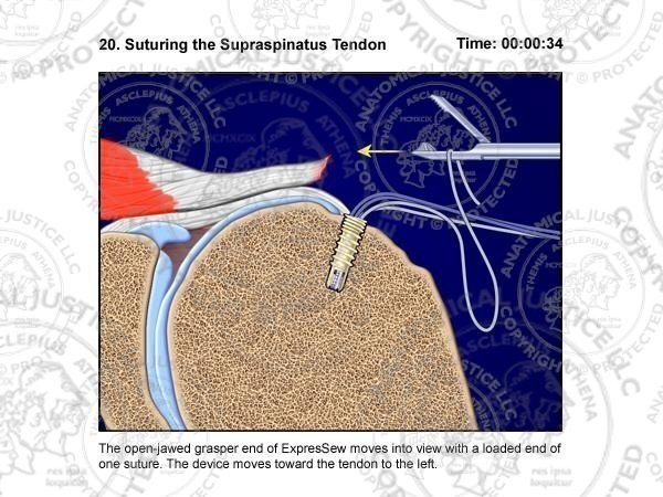 Arthroscopic Rotator Cuff Repair Surgical Storyboards