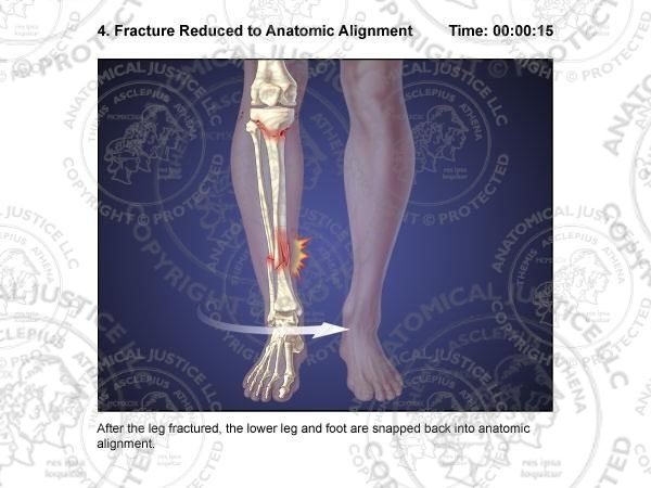 Tibial Fracture, Reduction and External Fixation Storyboards
