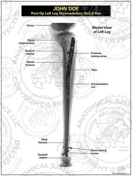 Post-Op Left Leg Intramedullary Rod Negative and Positive X-Rays