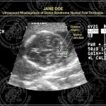 Ultrasound Misdiagnosis of Down Syndrome Nuchal Fold Thickness