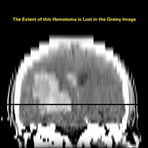 The Extent of this Hematoma is Lost in the Grainy Image