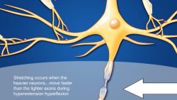 Contrecoup Injury Animation – Part 3 – Axon Stretching