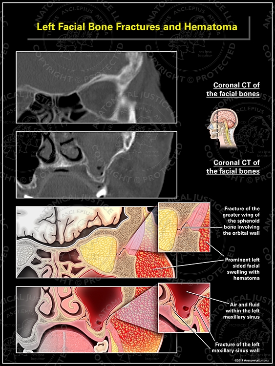 Left Facial Bone Fractures and Hematoma