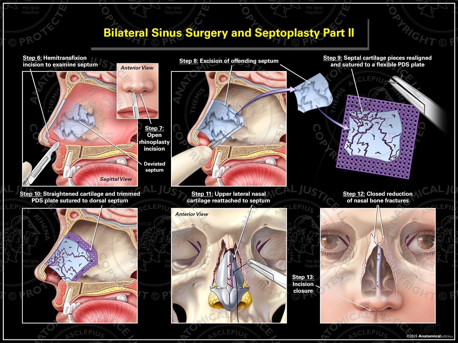 Six illustrations depict a septoplasty and closed reduction of nasal bone fractures.