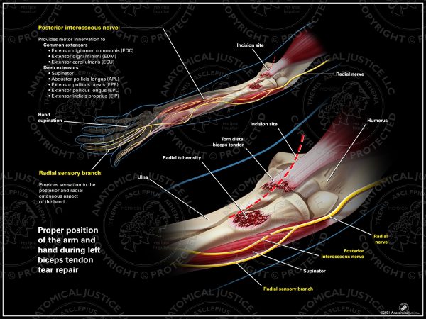 An illustration of the forearm in the correct, supine position is on the top half of the exhibit, and an enlargement of the incision site over the elbow is below. The left radial nerve is safely not under the incision site.