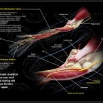An illustration of the forearm in the incorrect, prone position is on the top half of the exhibit, and an enlargement of the incision site over the elbow, showing the left radial nerve, is below.