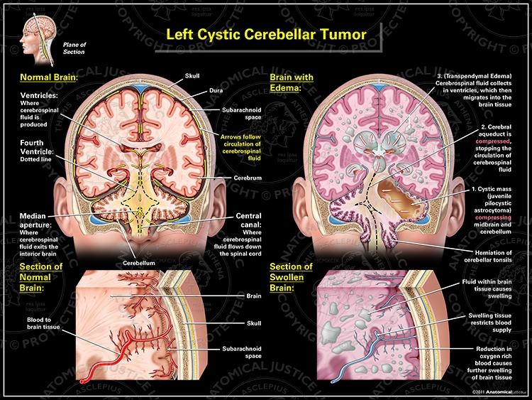 Left Cystic Cerebellar Tumor