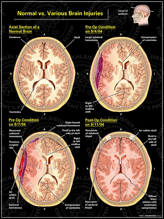 Normal vs. Various Brain Injuries