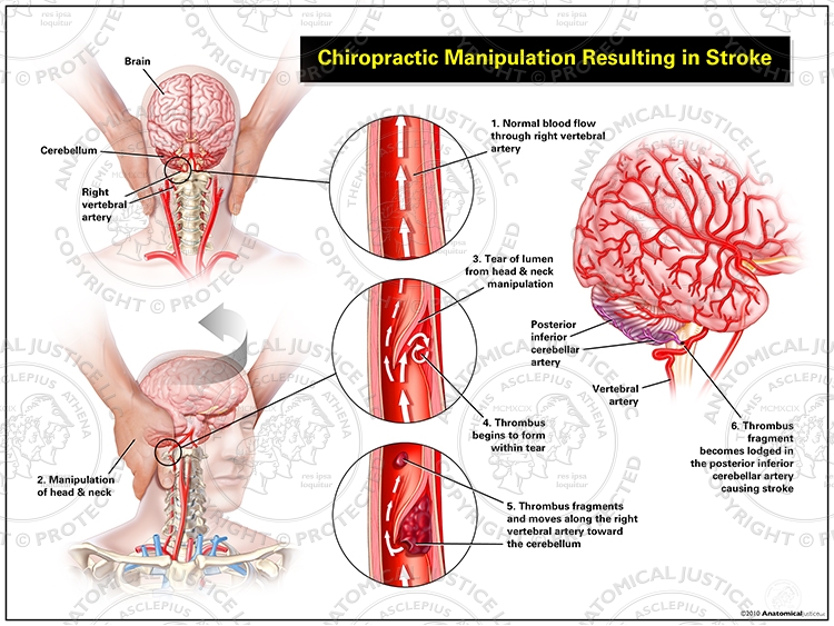Chiropractic Manipulation Resulting in Stroke