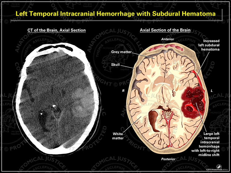 Left Temporal Intracranial Hemorrhage with Subdural Hematoma
