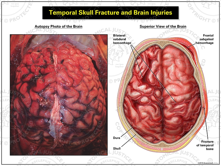 Temporal Skull Fracture and Brain Injuries