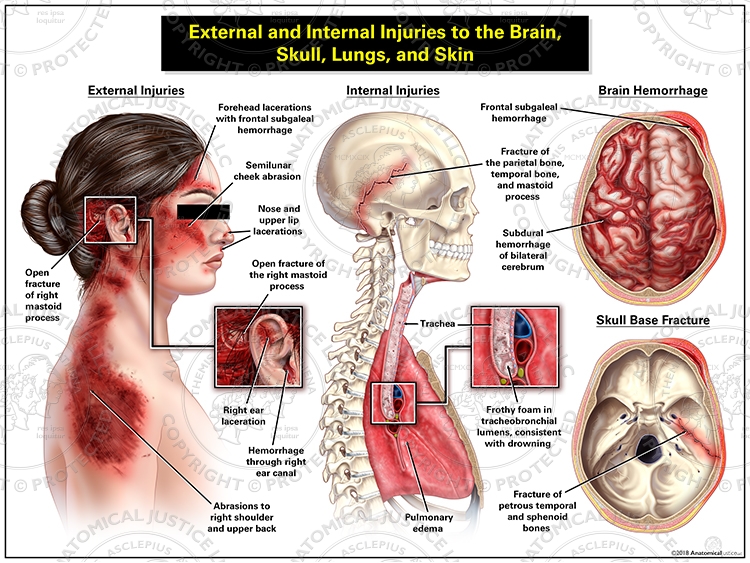 Internal and External Injuries to the Brain, Skull, Lungs, and Skin