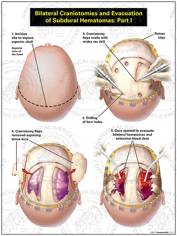 Bilateral Craniotomies and Evacuation of Subdural Hematomas