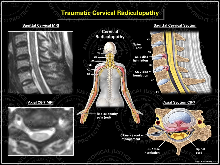 Traumatic Cervical Radiculopathy